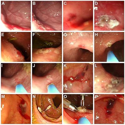 Application of Argon Plasma Coagulation for Gastrointestinal Angiodysplasia in Children— Experience From a Tertiary Center